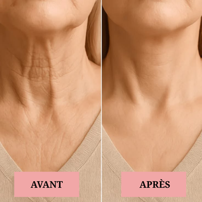Lifting du visage