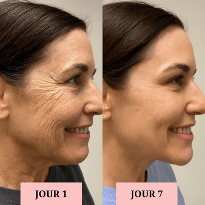 Lifting du visage