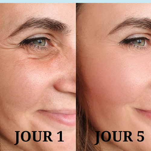 Lifting du visage